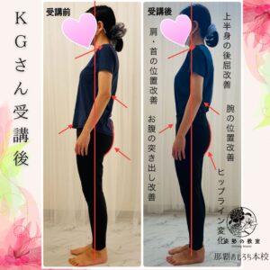 KGさん猫背反り腰受講後変化