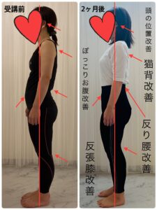 NKさん2ヶ月後姿勢変化