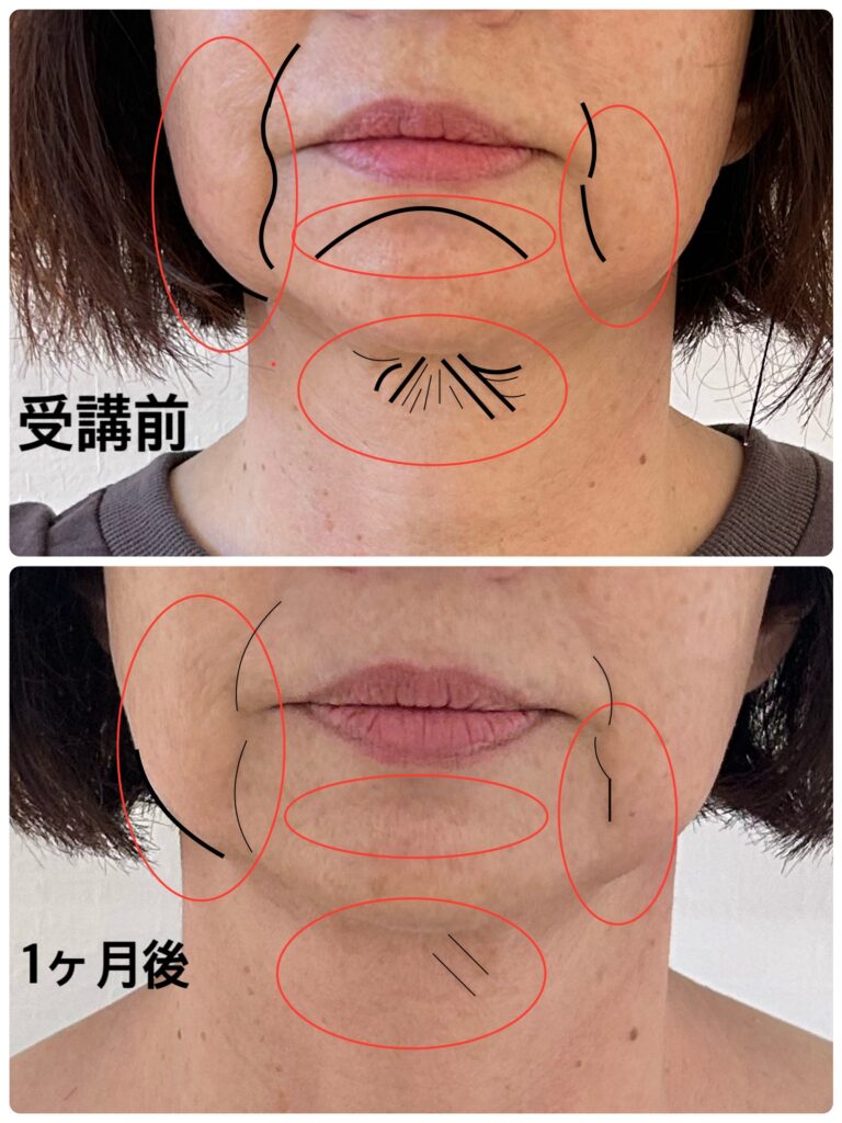 表情筋の教室　受講生ビフォーアフター